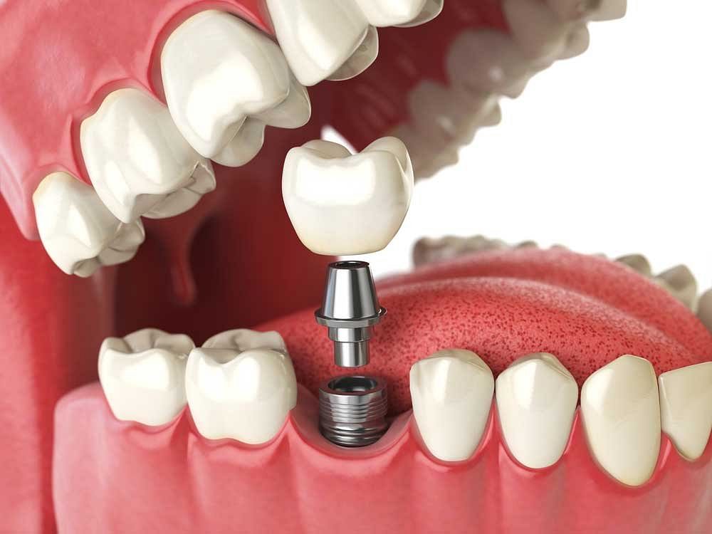 Single Dental Implants Fremont, CA