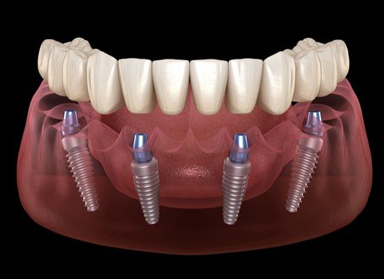 Dental Implant Cost Fremont, CA