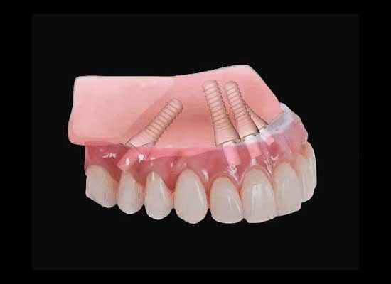 Dental Implant Cost Fremont, CA