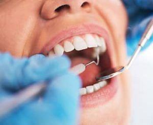 dental-extractions