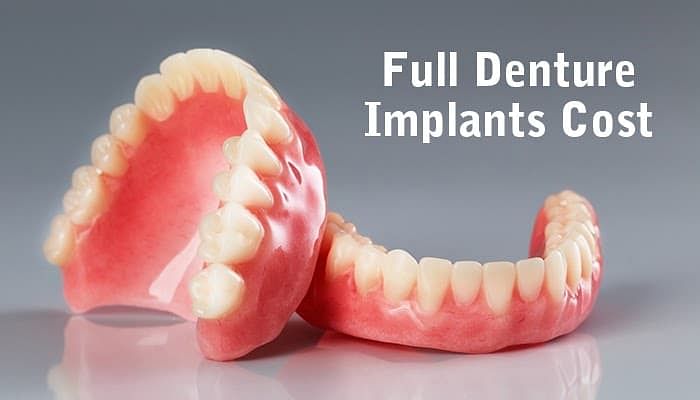 Full Denture Implants Cost - CID