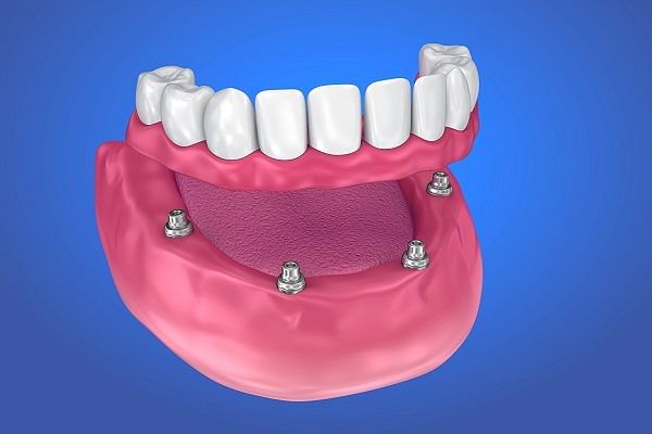 all-on-4-dental-implants-1