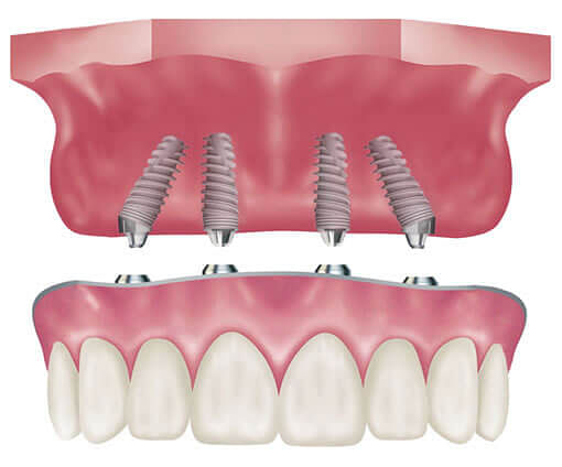 FAQs on All-on-4 Dental Implants